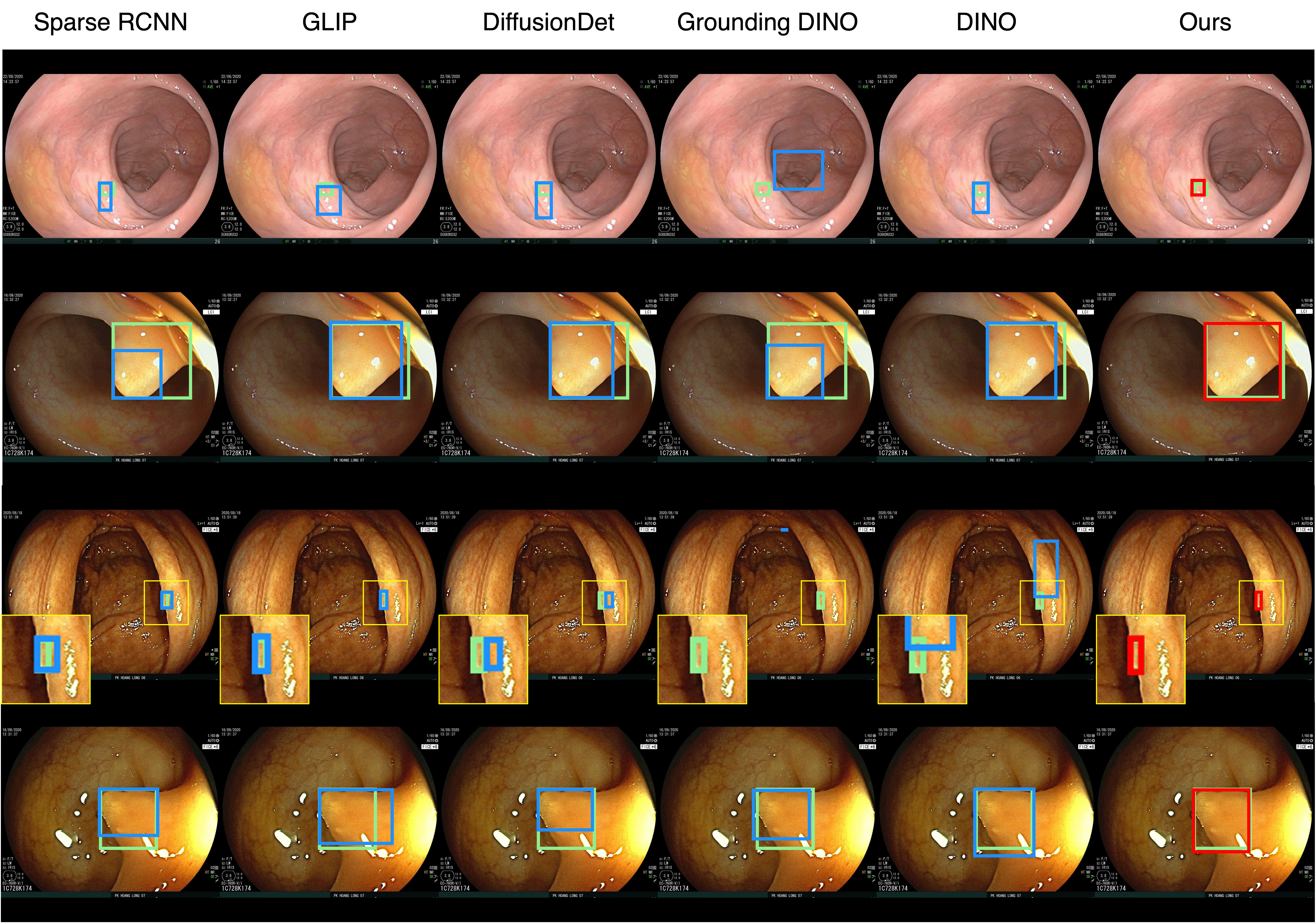 Colonoscopy qualitative results